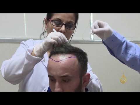 زراعة الشعر في تركيا تجتذب العرب والأوروبيين