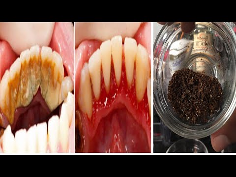 بالفيديو  وصفة للتخلص من الجير وتسوس الأسنان