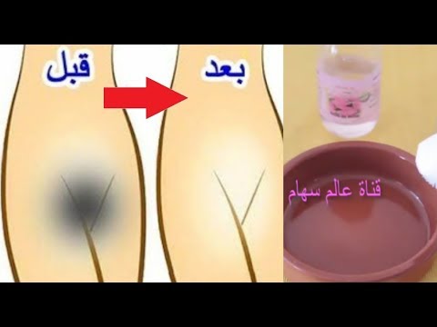 وصفة توضع على المنطقة الحساسة لمدة 30 دقيقة