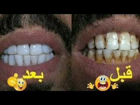 خلطة سهلة للحصول على أسنان بيضاء