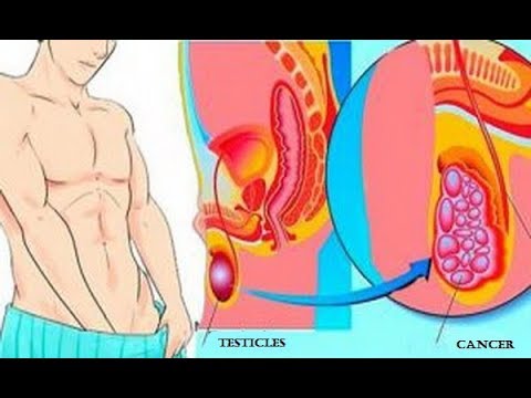 بالفيديو  احذر قد يكون لديك سرطان الخصية 