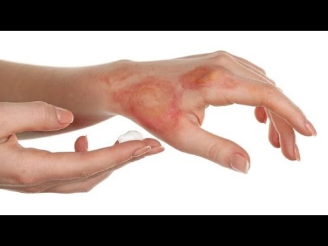 تعرف على أسرع طرق لعلاج الحروق
