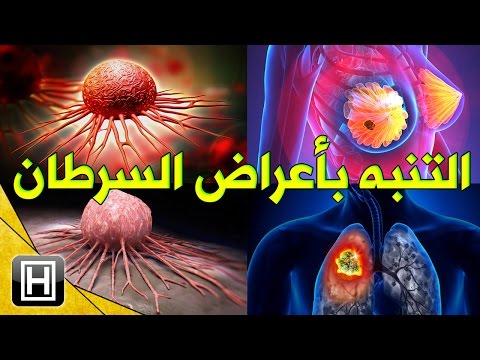 تعرف على أعراض السرطان العامة للتصدي لها