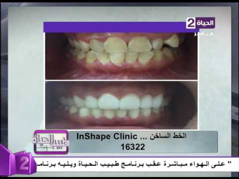 نتائج مبهرة بعد عملية تجميل الأسنان