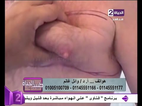 بالفيديو علاج ترهل الثدي عند الرجال