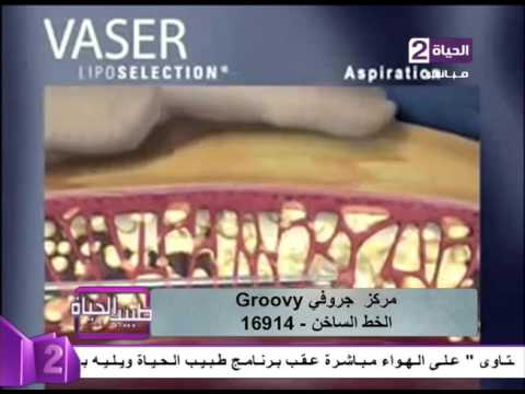 بالفيديو تعرّف على الفيزر وقدرته على تكسير الدهون وإستخلاصها من الجسم