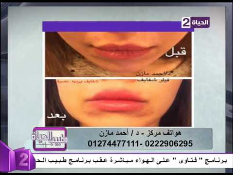 شكل الشفايف بعد حقنها بالفيلر