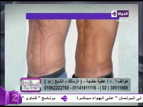 بالفيديو نتائج مبهرة بعد التخلّص من السمنة الزائدة