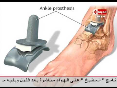 شاهد كيف يتم تغيير المفاصل