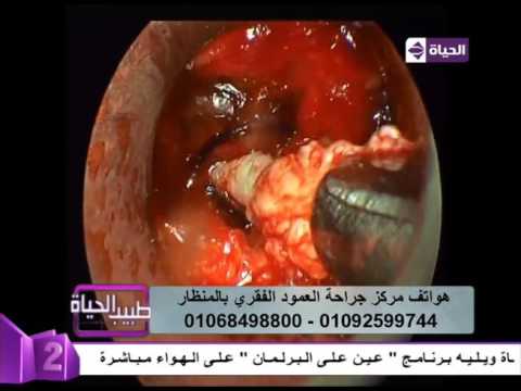 بالفيديو كيفية جراحة العمود الفقري بالمنظار