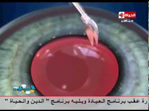 شاهد فيديو لحالة تجري عملية إزالة المياه البيضاء