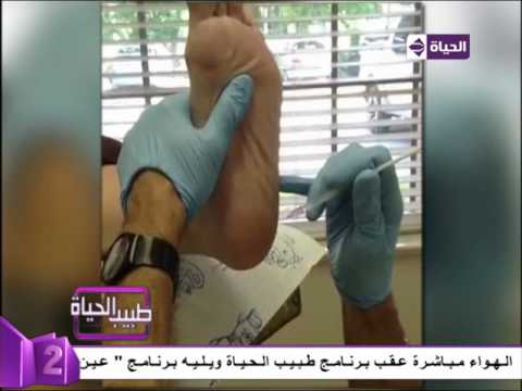 بالفيديو كيفية علاج الشوكة العظمية للمريض